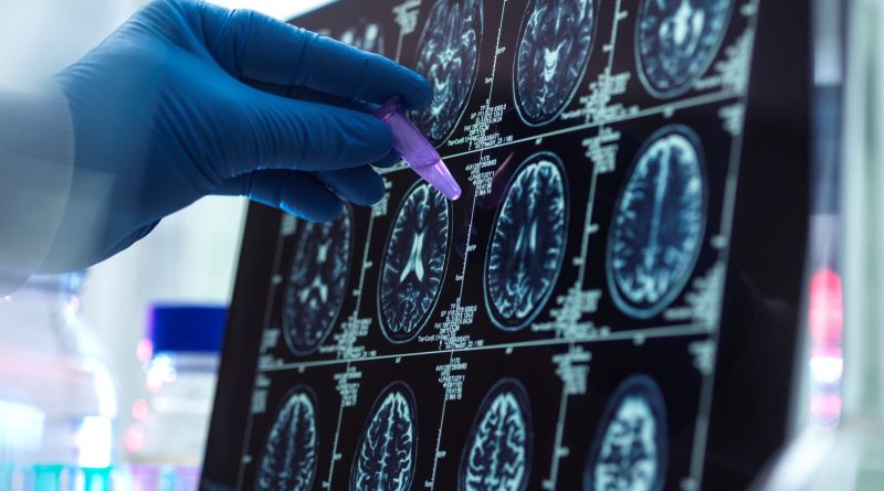 Un nuevo análisis permite detectar el alzhéimer a partir de un pinchazo en el dedo